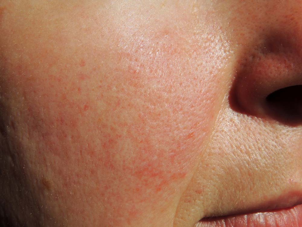 Treat And Soothe Rosacea