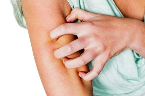 Treat Mosquito Bites Quickly
