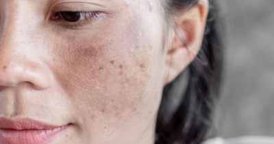 Can you repair sun damaged skin?