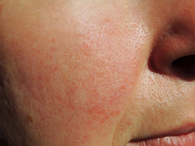 How To Treat And Soothe Rosacea