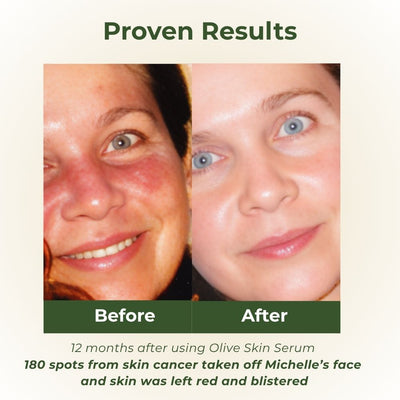 Olive Skin Serum before and after treats skin cancer scars