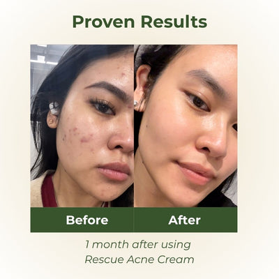Rescue Acne Cream before and after skin transformation