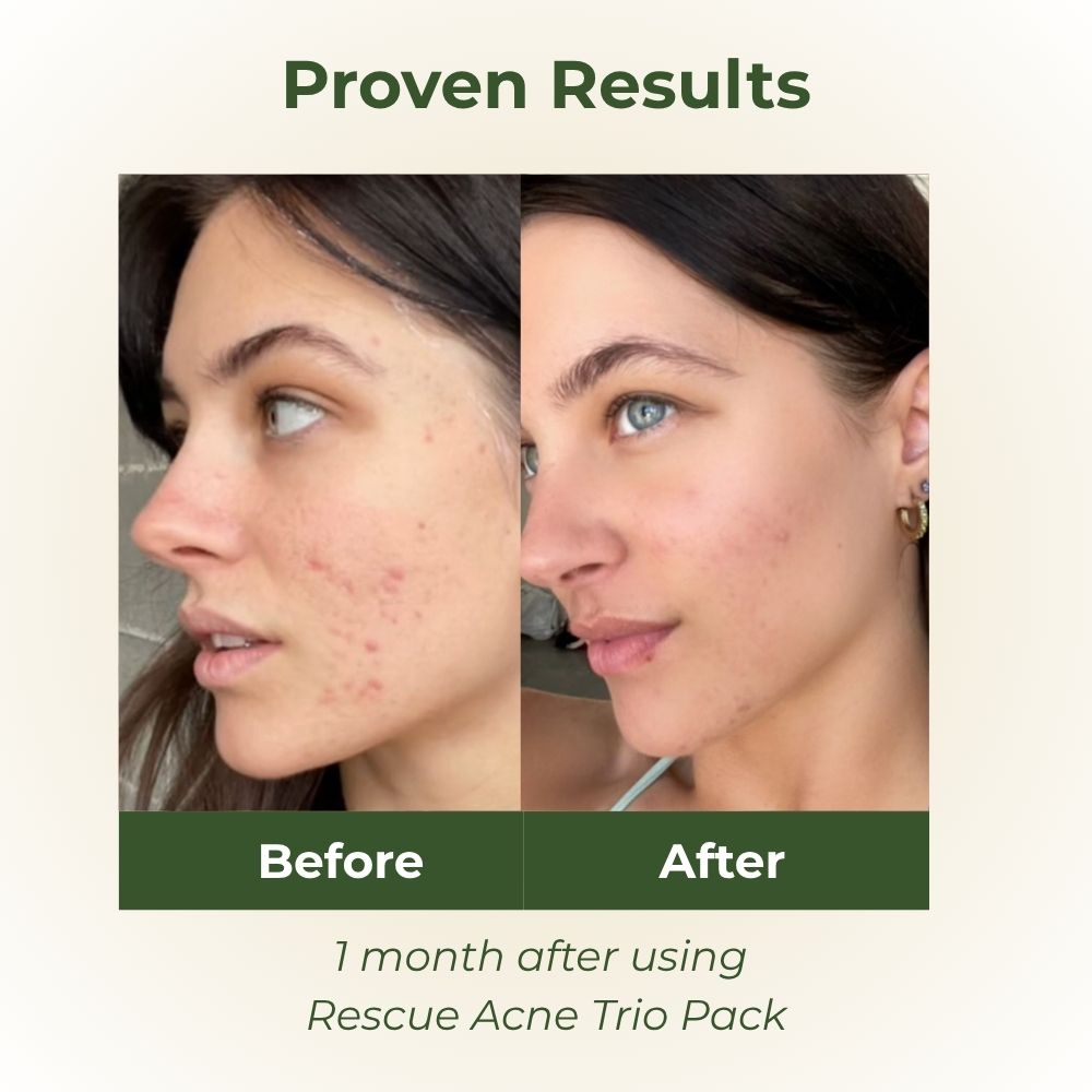 Rescue Acne Trio Pack