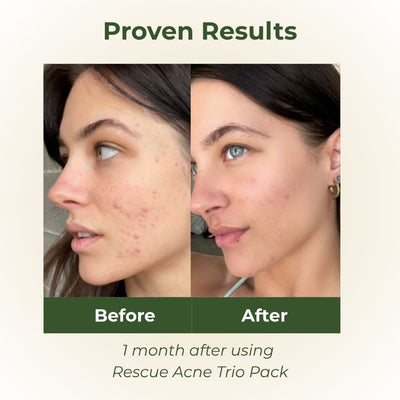 Rescue Acne Trio Pack